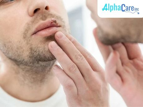Best Cold Sore Treatment and Overview